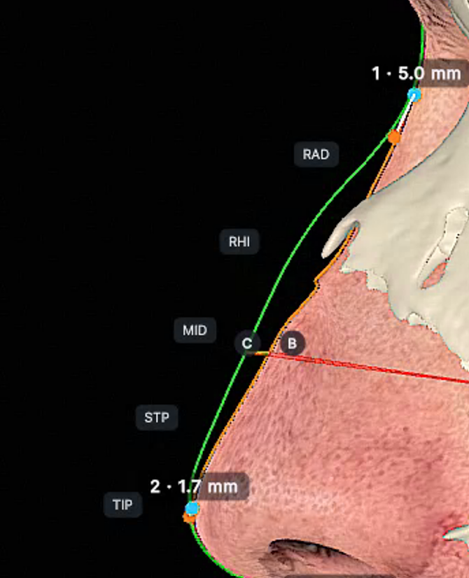 How AI Is Replacing the $50,000 Scanner in Your Surgeon’s Office
